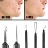 Pete & Pedro Acne & Blackhead Remover Skin Care Tool Set for Men & Women – 5 Piece Pimple Popper Kit + Mirror! | Removal of Whiteheads, Zits, Black Heads, Comedone Extractor | As Seen on Shark Tank